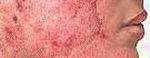 Acne on face