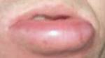 Pictures of Bee Sting