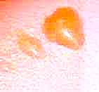 Sunburn blisters