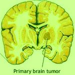 Tumor in Human