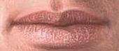 Chapped Lips