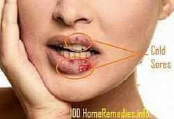 cold sores treatment cold sores treatment