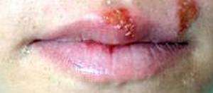 cold sores picture