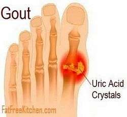 picture of gout in toe