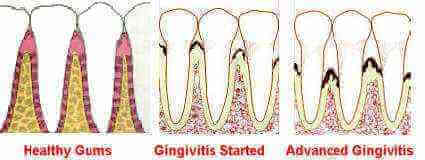 Healthy gums, Gingivitis