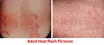 Adult Heat Rash Picture
