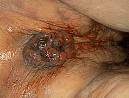 Hemorrhoids picture