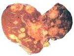 Liver Cancer picture
