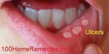 canker sores mouth ulcers treatment