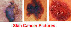 Skin Cancer Pictures