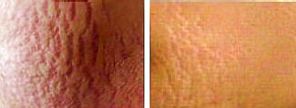 Stretch marks